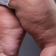 lipedema