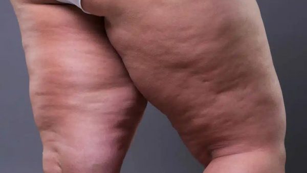 lipedema