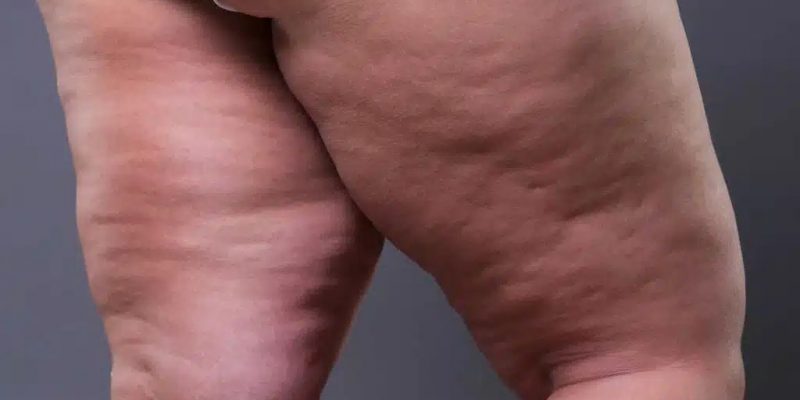 lipedema